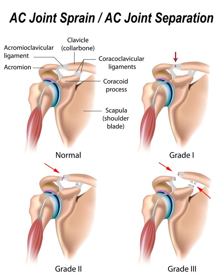 AC joint separation